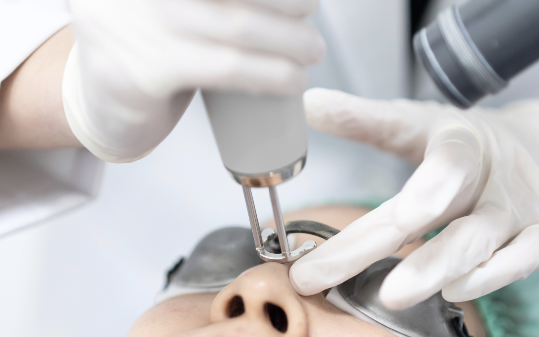 Acne Scar Laser Treatments for Clearer Skin by Fall in Gaithersburg, MD